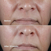 Clinique Smart Clinical Repair Wrinkle Correcting Rich Face Cream Before and After